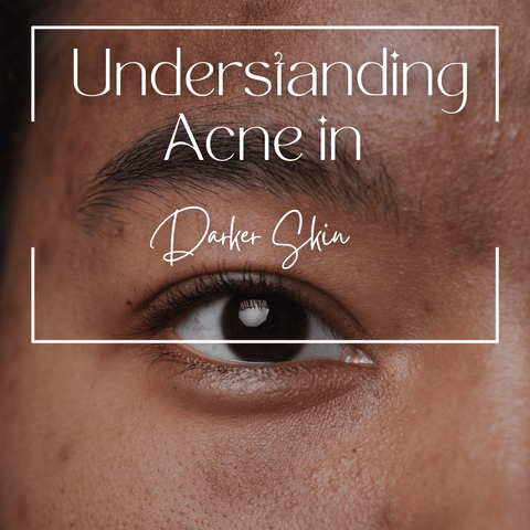 Understanding Acne in Darker Skin
