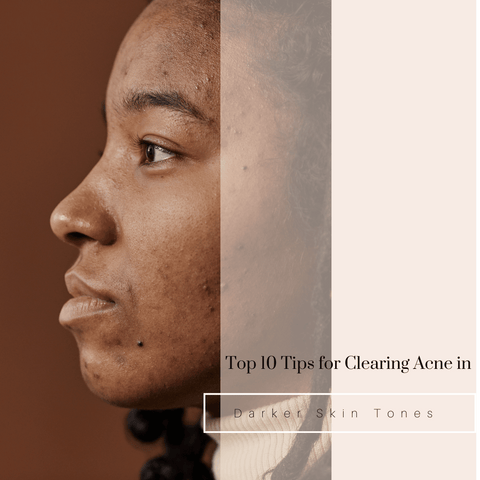 Top 10 Tips for Clearing Acne in Darker Skin Tones