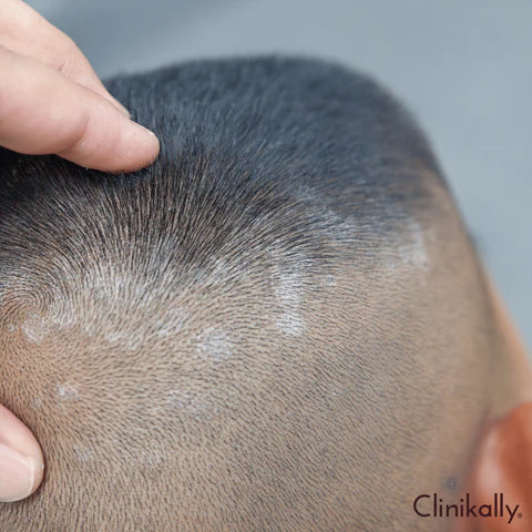 Causes of itchy scalp and dandruff