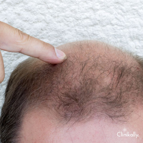 Lifestyle factors contributing to baldness