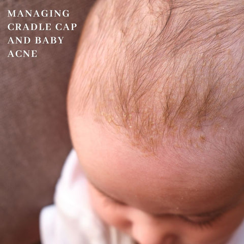 Managing cradle cap and baby acne