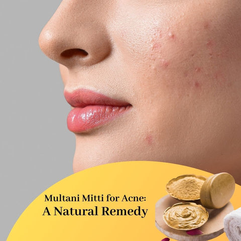 Multani Mitti for Acne: A Natural Remedy