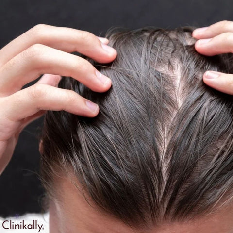 Optimizing Your Hair Health: Strategies Beyond Finasteride