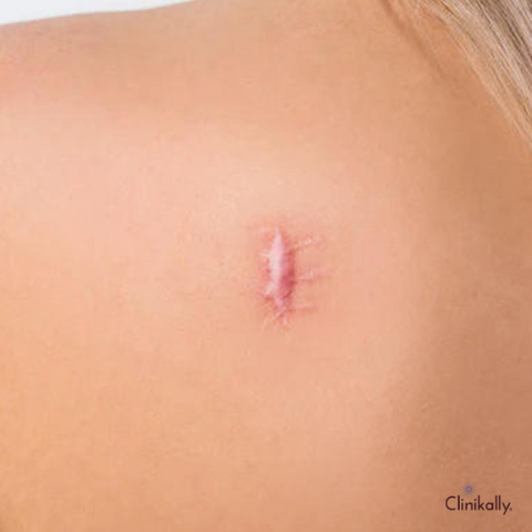 Scar from stitches How to prevent it : causes, treatments, products by La  Roche-Posay