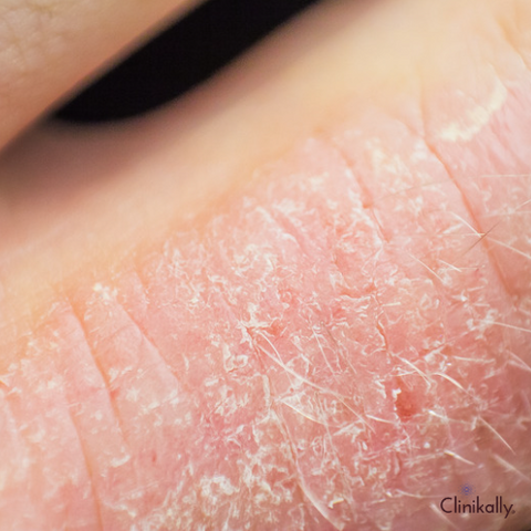 Managing Eczema on Lips: Understanding the Causes, Treatment Options, and Prevention Tips