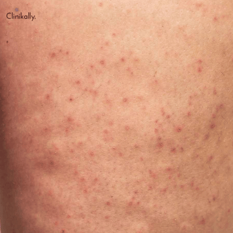 keratosis pilaris treatment