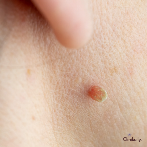 Skin Tags and Their Causes