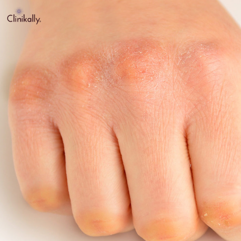 How to Treat Dark Knuckles and Get Even-toned Knuckles