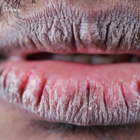 dark lips treatment