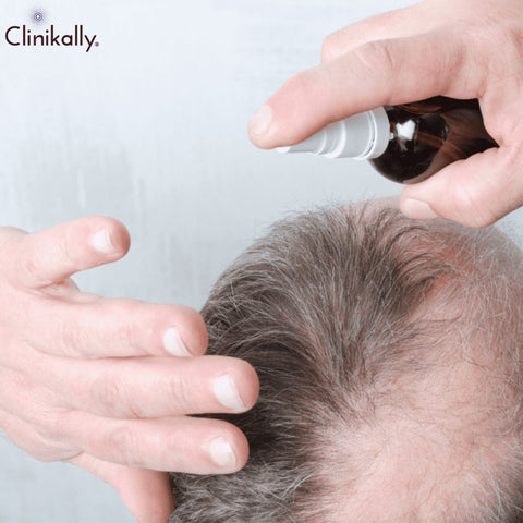 Providing recommendations for individuals considering topical finasteride as a hair loss treatment option