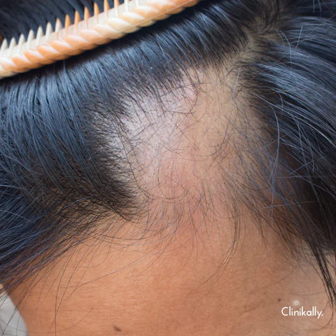 Managing potential scalp reactions to Redensyl