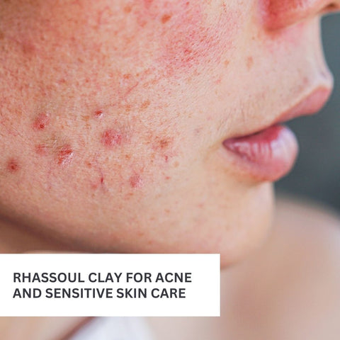 Rhassoul Clay for Acne and Sensitive Skin Care