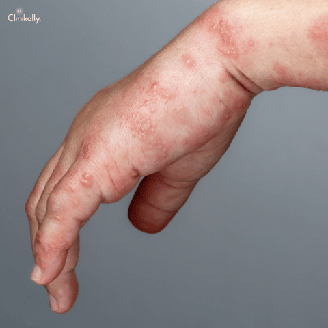 Scabies Duration: Causes, Symptoms, and Treatment Timeline