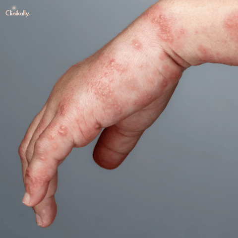 scabies rash