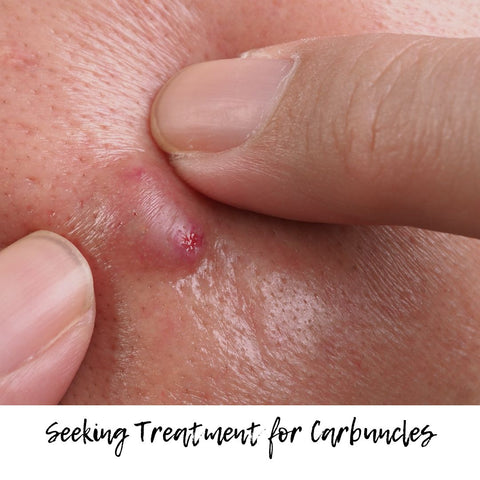 Seeking Treatment for Carbuncles