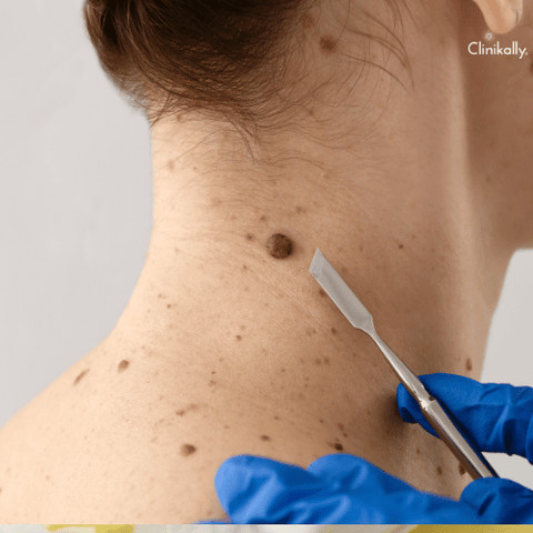 intradermal nevus