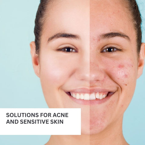 Solutions for Acne and Sensitive Skin