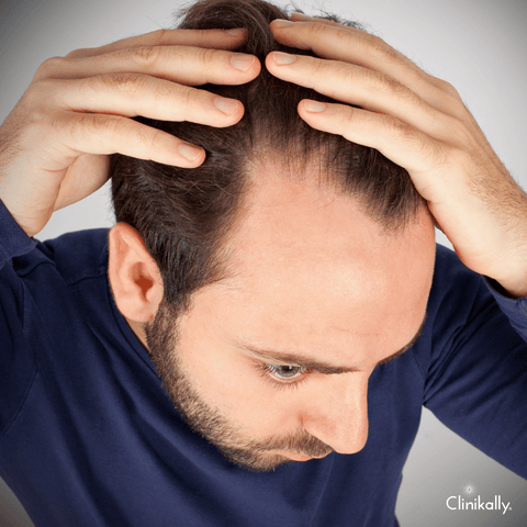 What Happens After You Stop Minoxidil Use?