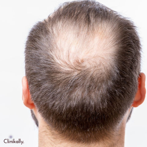 Symptoms of male pattern baldness