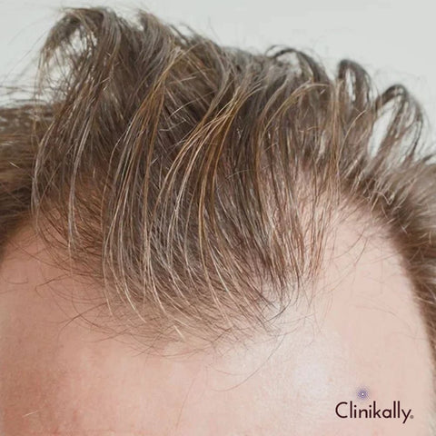 Takeaway: Topical finasteride for hair loss
