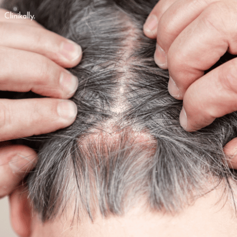 Symptoms of scalp psoriasis