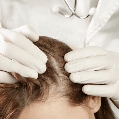 How to treat scalp psoriasis