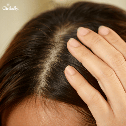 How to treat scalp psoriasis