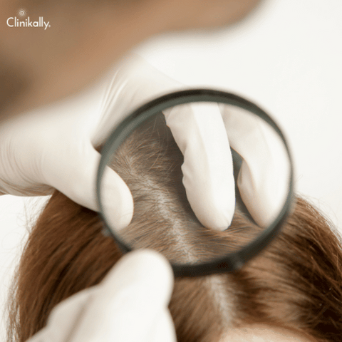 Causes of scalp psoriasis