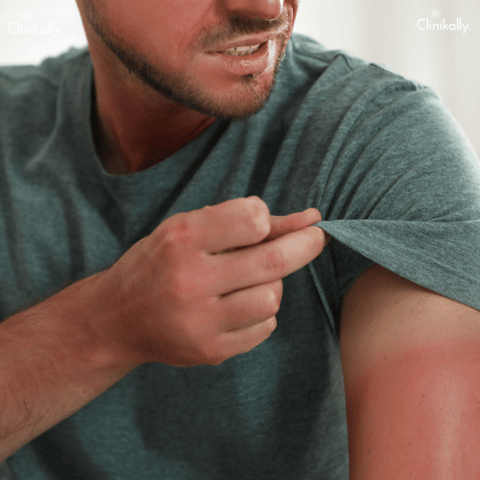 Traveling skin rash