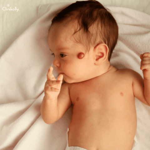 Infantile Hemangioma (Strawberry Birthmark)