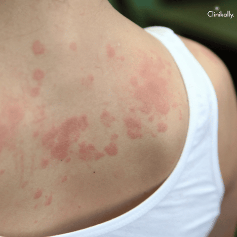 Traveling skin rash