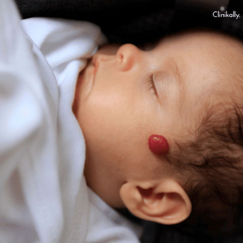  Infantile Hemangioma