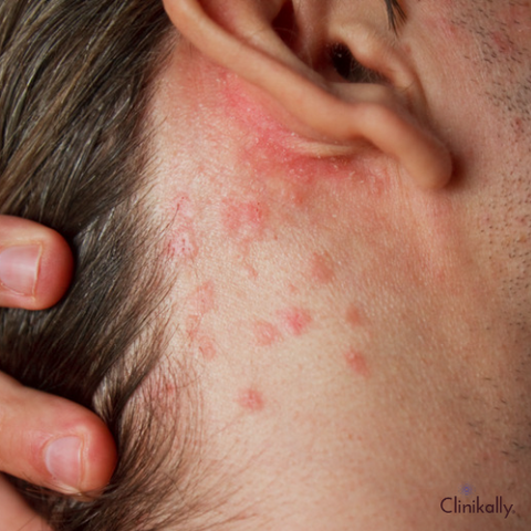 Heat Rash in Adults Causes, Symptoms, and Effective Treatments