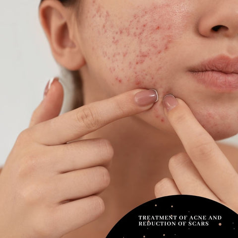 Treatment of Acne and Reduction of Scars