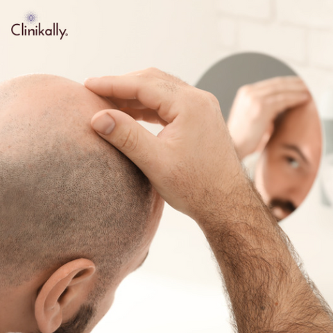 What Happens After You Stop Minoxidil Use?