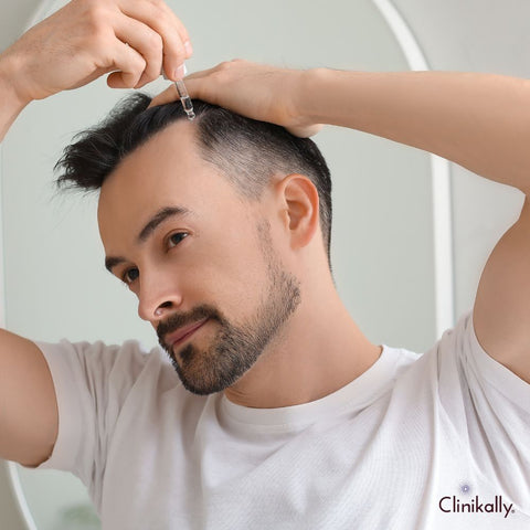 Treatment options for male pattern baldness
