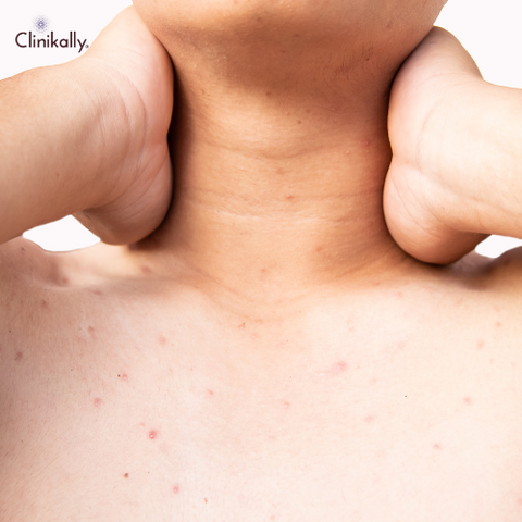 Chest Acne Causes, Treatments, and Prevention