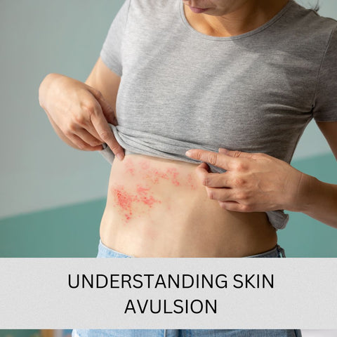 Understanding Skin Avulsion