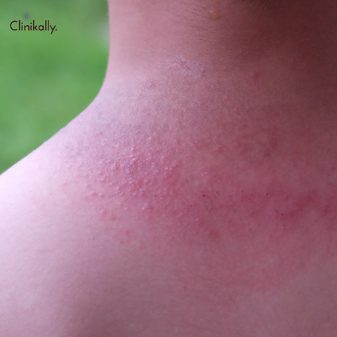 adult heat rash on neck