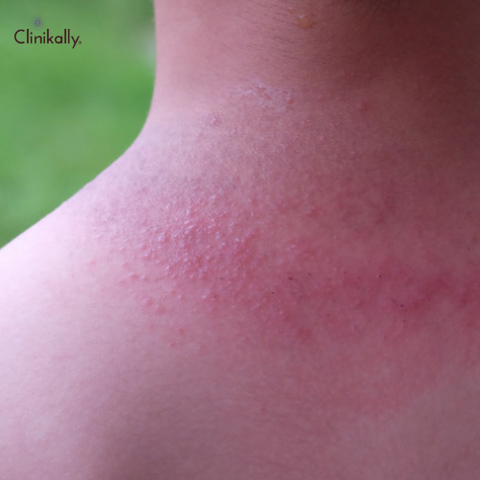 Heat Rash in Adults Causes, Symptoms, and Effective Treatments