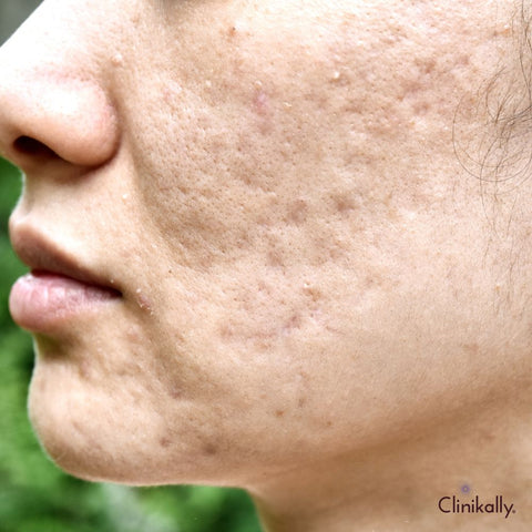 Understanding the Dynamics: Dry Skin, Hormones, and Breakouts