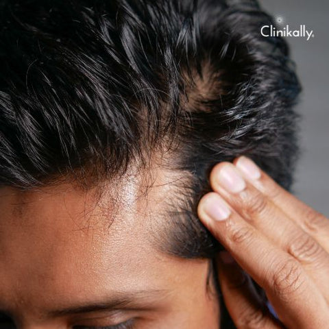 Breaking Down the Gender Differences in Hair Loss: What You Need to Know