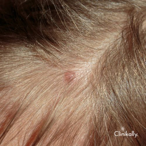 Decoding Scalp Acne: Understanding Causes and Finding Solutions