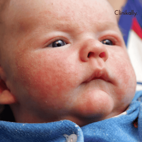 Eczema in children