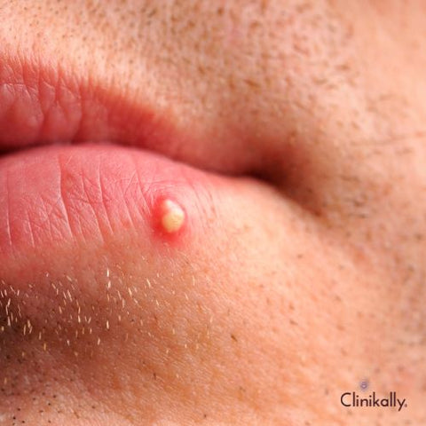 How to Get Rid of Pimple on Lip: Tips and Tricks