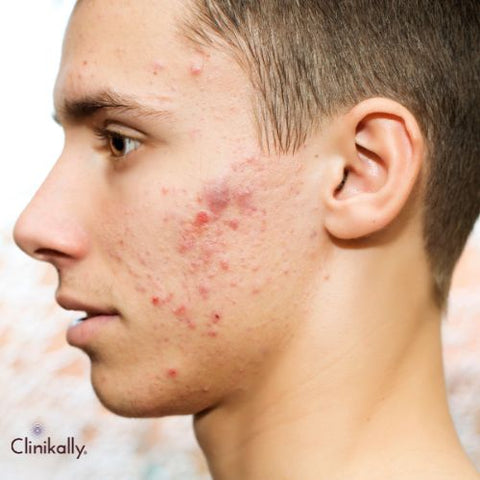 Identifying and Treating Different Types of Acne