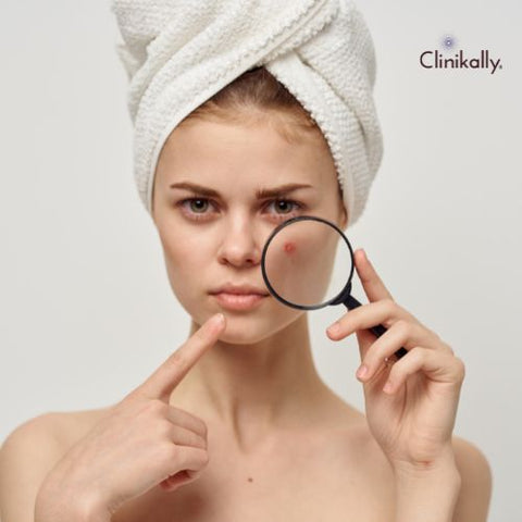 Identifying and Treating Different Types of Acne