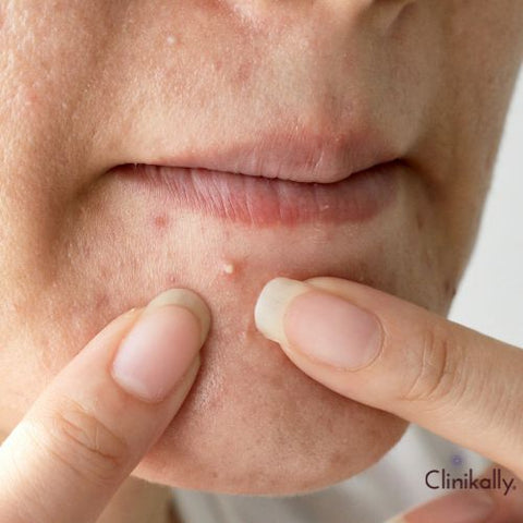 How to Get Rid of Pimple on Lip: Tips and Tricks