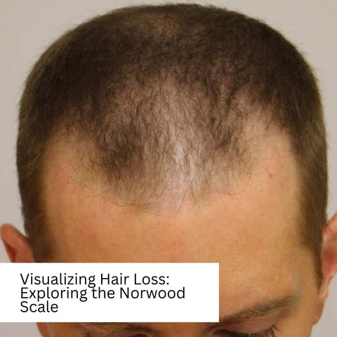 Visualizing Hair Loss: Exploring the Norwood Scale
