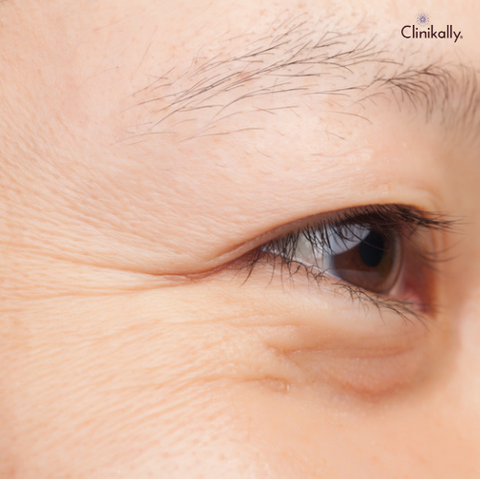 https://cdn.shopify.com/s/files/1/0532/0998/9283/files/What_are_fine_lines_and_wrinkles_2_480x480.png?v=1678971341